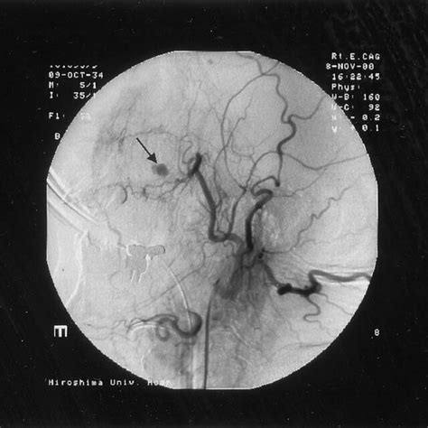 A Right External Carotid Angiogram Demonstrating A Pseudoaneurysm In