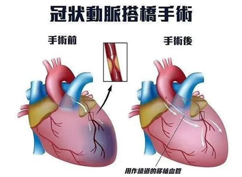 心里有普之冠心病血运重建 赣州市立医院