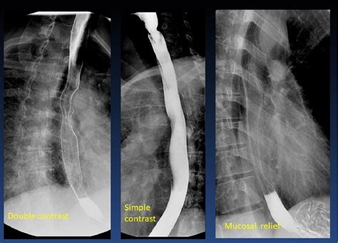 Figure 9 From Conventional Radiology In The Study Of Dysphagia The