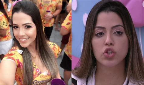 Foto Laís Caldas no antes e depois da harmonização facial Purepeople