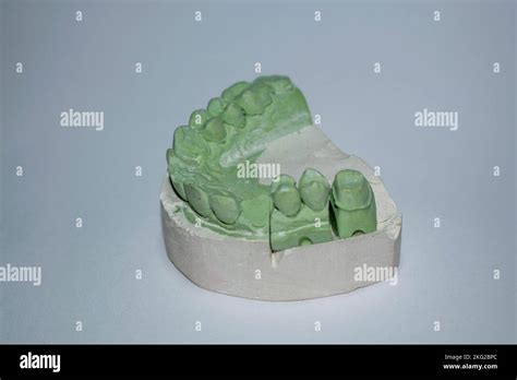 Plaster Impressions Of The Teeth Of The Lower A Jaw For Prosthetics And