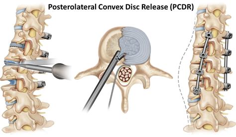 Posterolateral Fusion Surgery