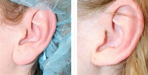 Earlobe Reduction And Repair In San Francisco Bay Area Ca San Francisco Plastic Surgery And