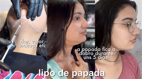 Fiz Lipo De Papada Enzim Tica Primeira Aplica O Youtube