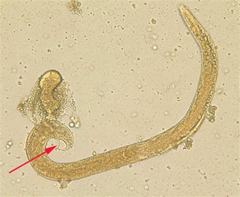 Strongyloides Stercoralis Symptoms