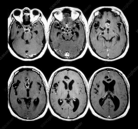 Mri Of Cysticercosis Stock Image M130 0947 Science Photo Library