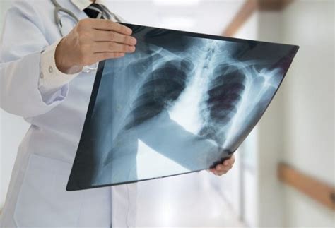 Cid N20 O Que Significa - CID N20 – Calculose do rim e do ureter