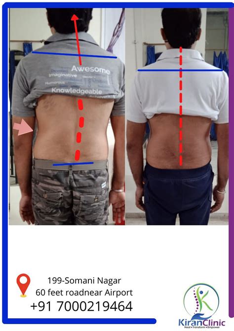 Pre and Post treatment Pictures - Kiran Clinics