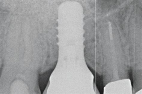 Lateral Sinus Lift With Cerabone And Jason Membrane One Stage