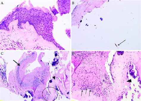 A Hematoxylin And Eosin Staining Of The Cyst Wall Shows Stratified