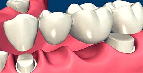 Dental bridge cost