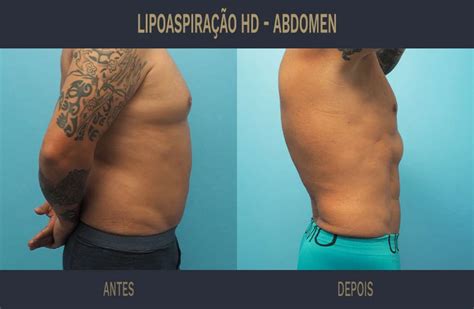 Lipoaspiração de Alta Definição HD Coimbra e Lisboa Dr Ricardo