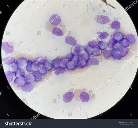 Blast Cells Peripheral Blood Smear Foto Stock Editar Agora 1813535452