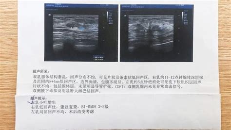 乳腺增生會癌變嗎？這些乳房健康知識，每個女性都要了解 每日頭條