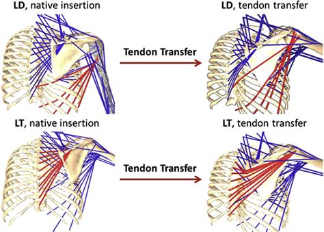 Biomechanics Of Lower Trapezius And Latissimus Dorsi Transfers In