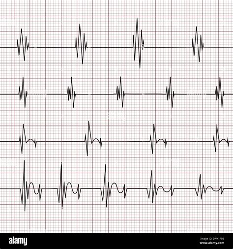 Multiple Ekg Electrocardiogram Graphs On A Grid Background Various