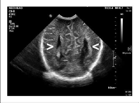 dandy walker ultrasound