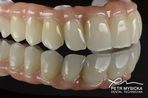 Zirconia All On 4 Bridge Brighton Implant Clinic Dental Implants