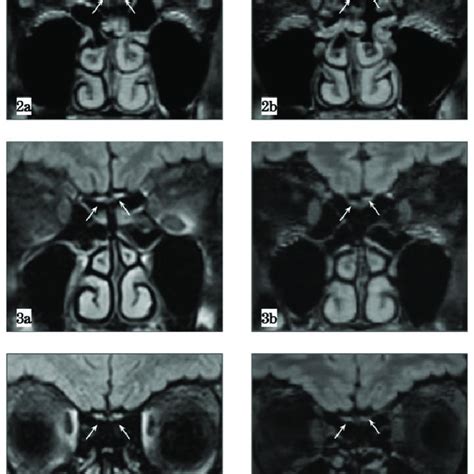 Magnetic Resonance Imaging Mri Showing Radiological Findings Of The