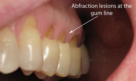 Abrasion Vs Attrition