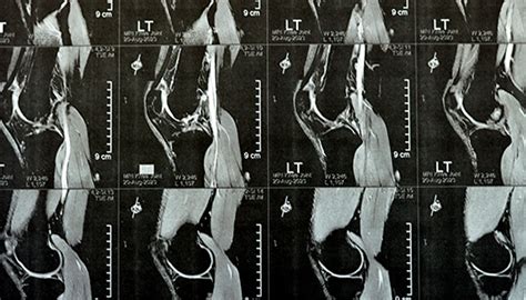 MCL Reconstruction - Dr. Adam Anz