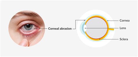 What Is The Fastest Way To Heal A Scratched Eye Smartbuyglasses Uk