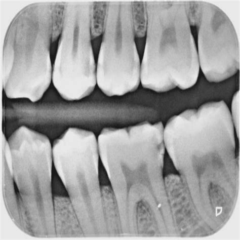 Caries Detection Instance Segmentation Dataset and Pre-Trained Model by ...