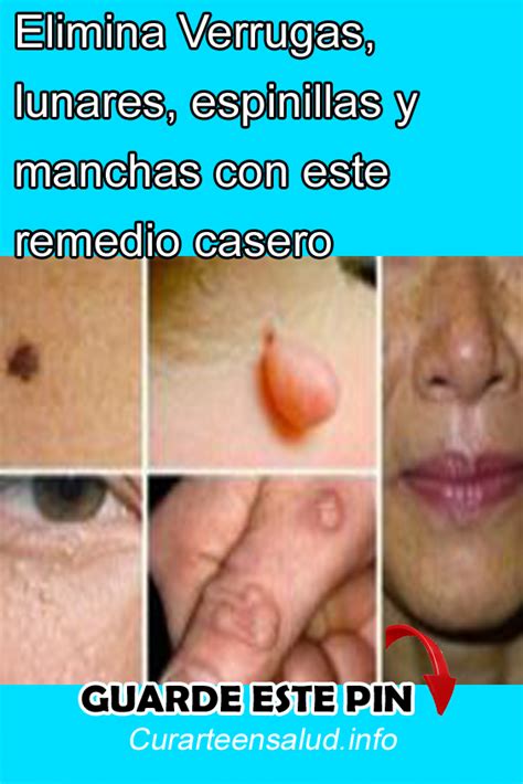 Elimina Verrugas Lunares Espinillas Y Manchas Con Este Remedio Casero