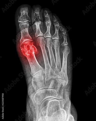 X-ray fracture of the first metatarsal bone - Buy this stock photo and explore similar images at ...