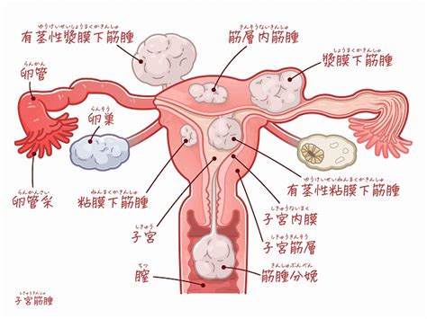 子宮筋腫・子宮内膜症・子宮腺筋症｜原因や症状・治療なら神戸の中野産婦人科へ