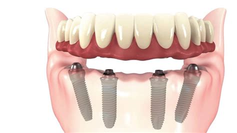 All On 4 Dental Implants Sterling Dental Clinic Dental Blogs India