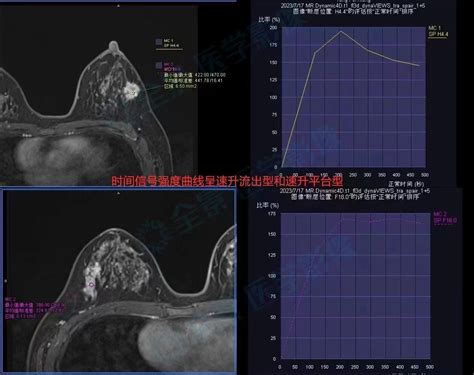 论乳腺磁共振动态增强检查重要性乳腺磁共振乳腺结节磁共振重要性乳腺癌淋巴结乳腺动态增强检查钼靶肿块彩超诊断病变 健康界