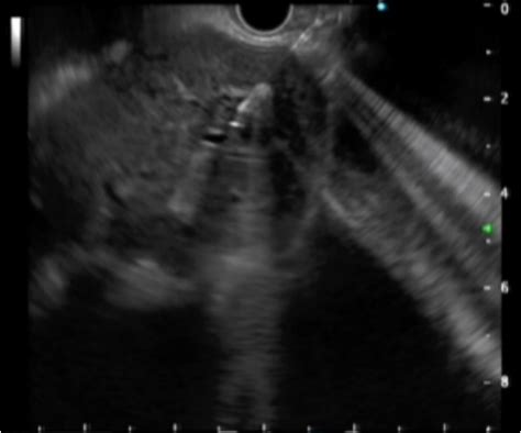 Figure 1 From Clinical Value Of Preferred Endoscopic Ultrasound Guided