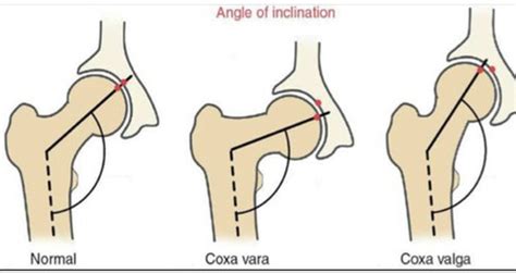 32: patellar luxation Flashcards | Quizlet