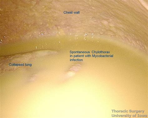 Thoracic Duct Chylothorax