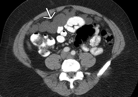 Benign Multicystic Peritoneal Mesothelioma AIRP Best Cases In