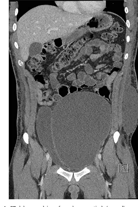 Figure 1 From Benign Cyst With Xanthogranulomatous Inflammation