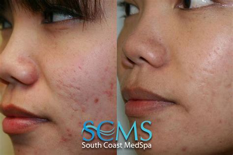 Acne Scar Removal South Coast Med Spa