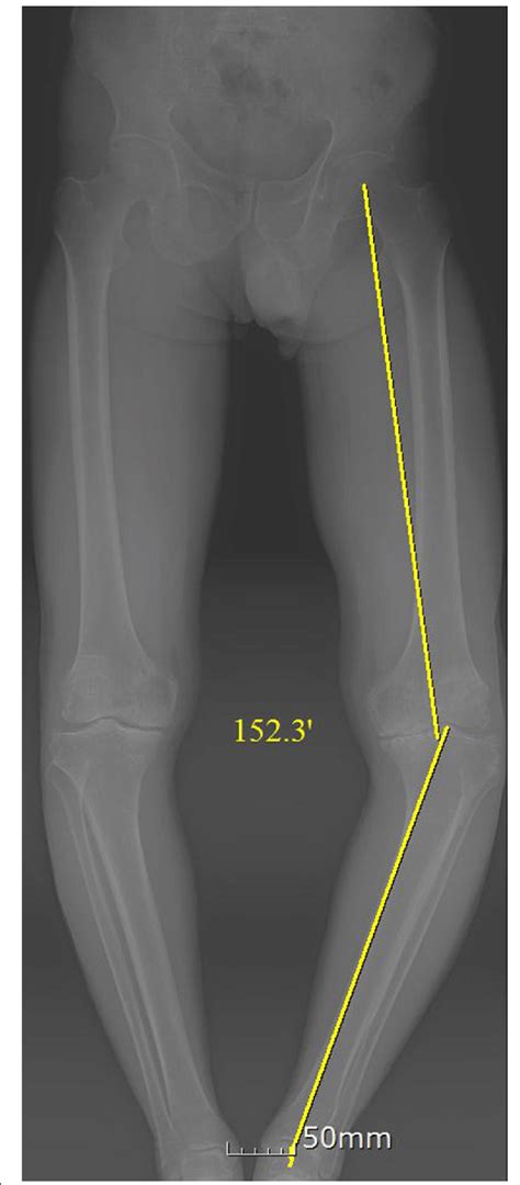 Preoperative Long Standing Anteroposterior Radiograph Of A Patient With