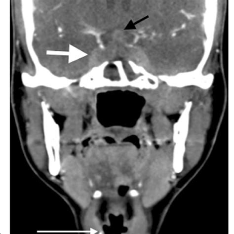 Axial Intracranial Contrast Enhanced T Weighted Mr Image After Six