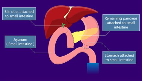 Whipple Procedure Memorialcare
