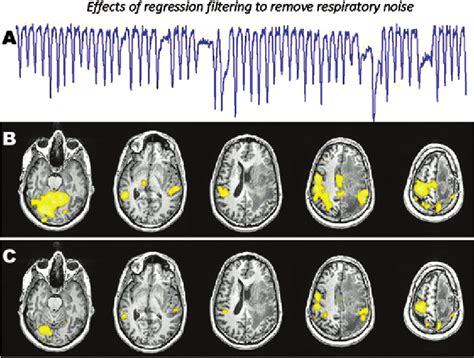 Functional Mri Fmri Activation Maps Depicting The Effects Of Download Scientific Diagram