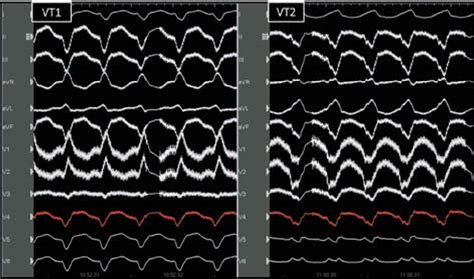 Figure 1 From Multipolar Mapping For Ventricular Tachycardia Ablation