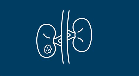 NKT2152 Shows Promising Efficacy in Advanced Clear Cell Kidney Cancer