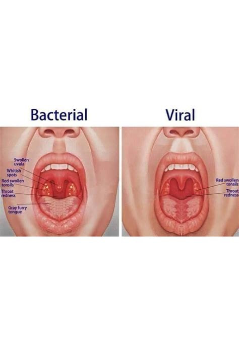 SOLUTION Tonsillitis Studypool