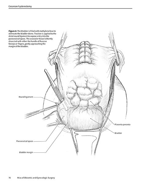 Surgical Cesarean Hysterectomy Evelyn Lockhart