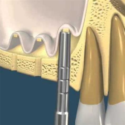 Bone Graft And Sinus Lift Artista Advanced Dentistry