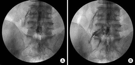 Epidural Neuroplasty Fluoroscopic Anterioposterior View A Left L5