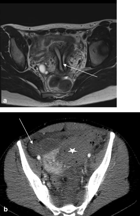 Uterine perforation in a 25-year-old woman following uterine septum ...