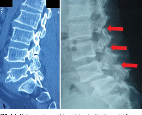 Figure 1 From Multiple Level Lumbar Spondylolysis And Spondylolisthesis